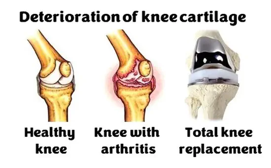 Does knee cartilage repair surgery prevent arthritis or the need for a joint replacement?