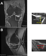 Combined Autologous Chondrocyte and Bone Marrow Mesenchymal Stromal Cell Implantation in the Knee: An 8-year Follow Up of Two First-In-Man Cases